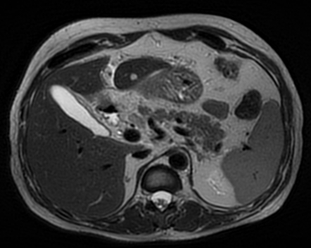 Perforated Gastric Ulcer With Hepatic Abscess Image Radiopaedia Org