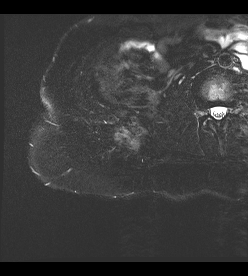 Extra Abdominal Desmoid Fibromatosis Image Radiopaedia Org