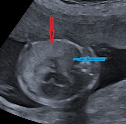 Congenital Lobar Overinflation Antenatal Ultrasound And MRI Image