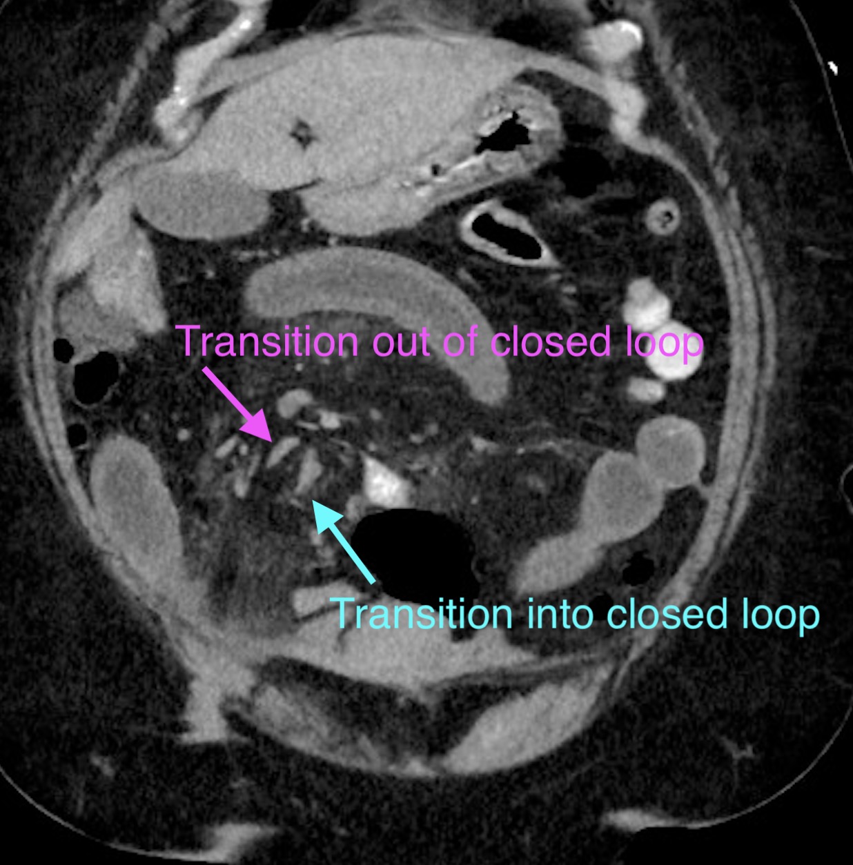 Complex Closed Loop Small Bowel Obstruction Adhesive Disease Image