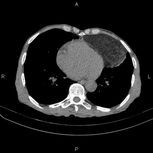 Giant Pericardial Lipoma Image Radiopaedia Org