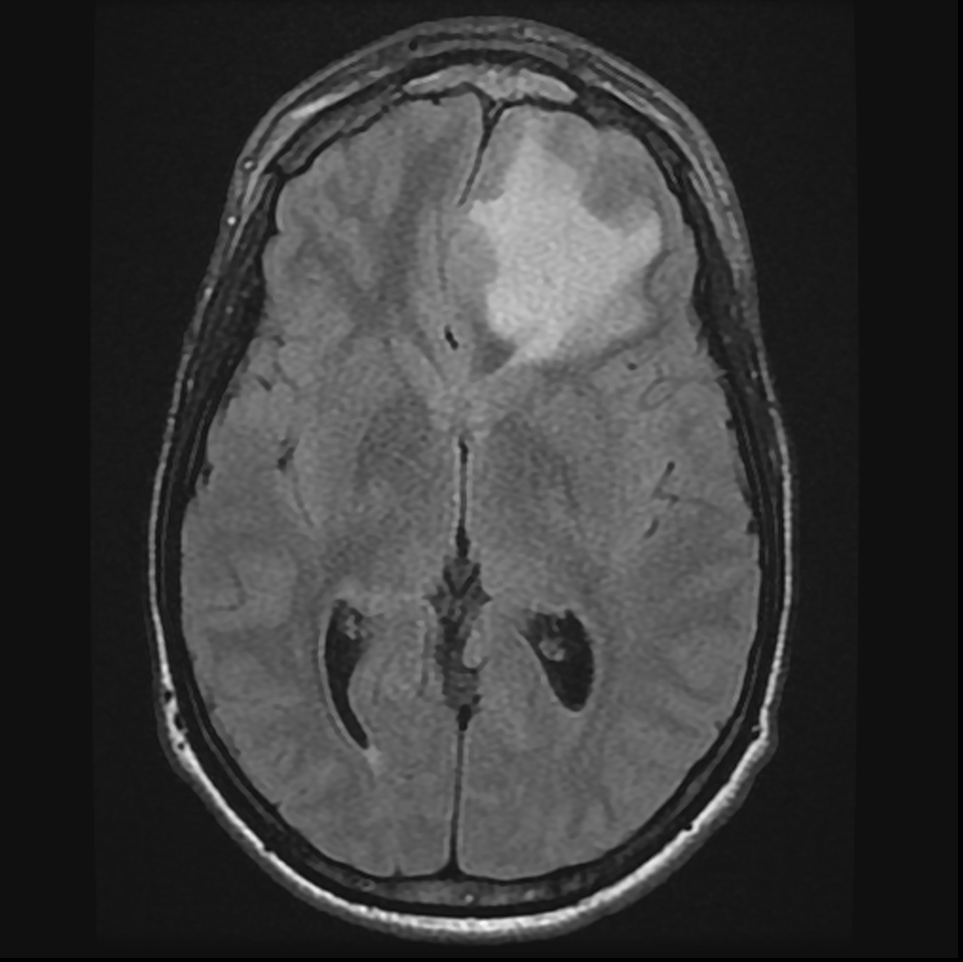 Pott Puffy Tumor And Cerebral Abscess Image Radiopaedia Org