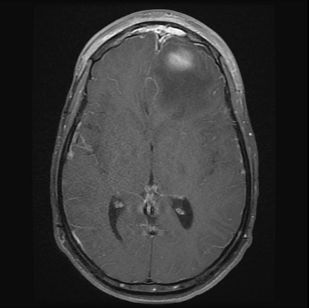 Pott Puffy Tumor And Cerebral Abscess Image Radiopaedia Org