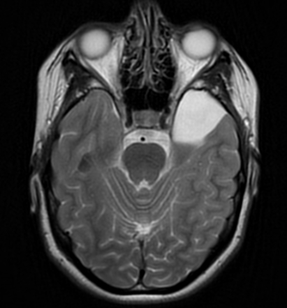 Arachnoid Cyst Middle Cranial Fossa Radiology Case Radiopaedia Org