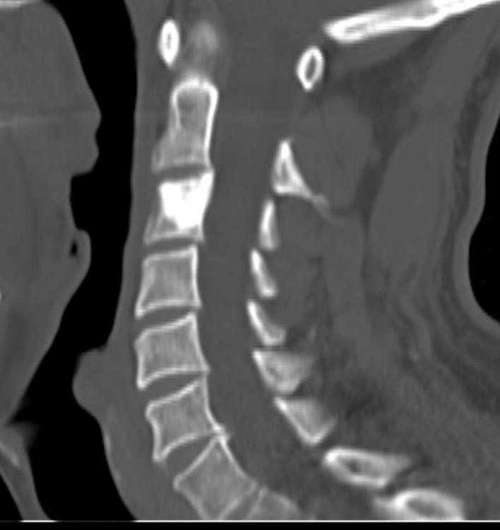 Osteoblastoma Cervical Spine Image Radiopaedia Org