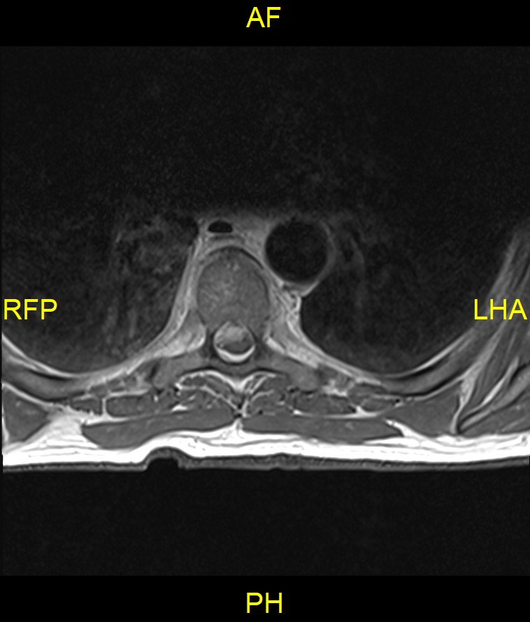 Discitis And Epidural Abscess Image Radiopaedia Org