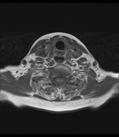 Zenker Diverticulum Image Radiopaediaorg