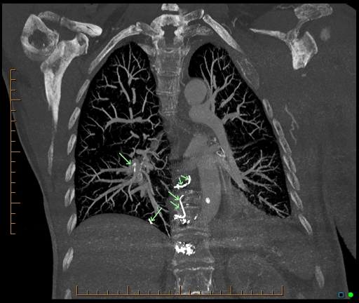 Pulmonary Cement Emboli Post Vertebroplasty Image Radiopaedia Org