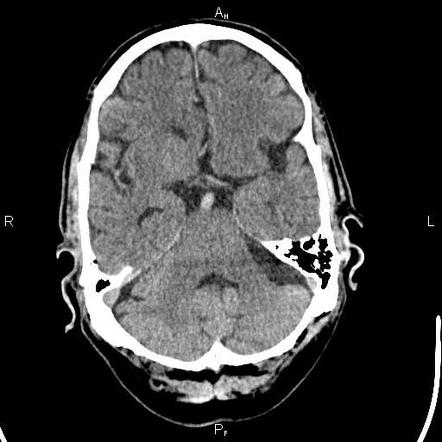 Cerebellopontine Angle Arachnoid Cyst Radiology Case Radiopaedia Org