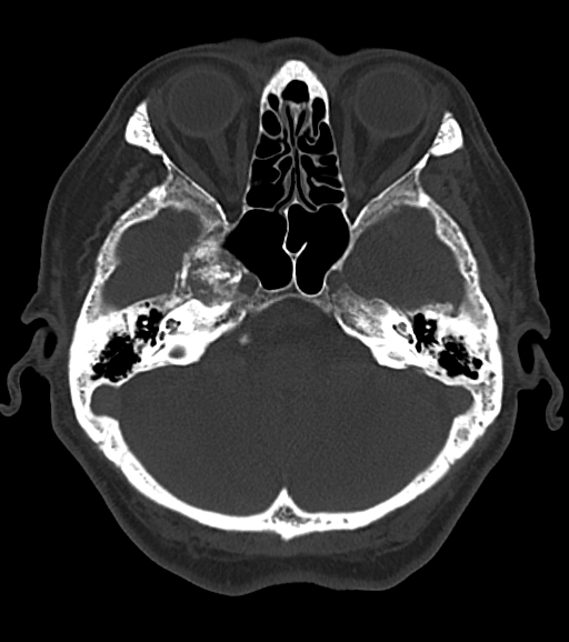 Petrous Apex Meningioma With Extracranial Spread Image Radiopaedia Org