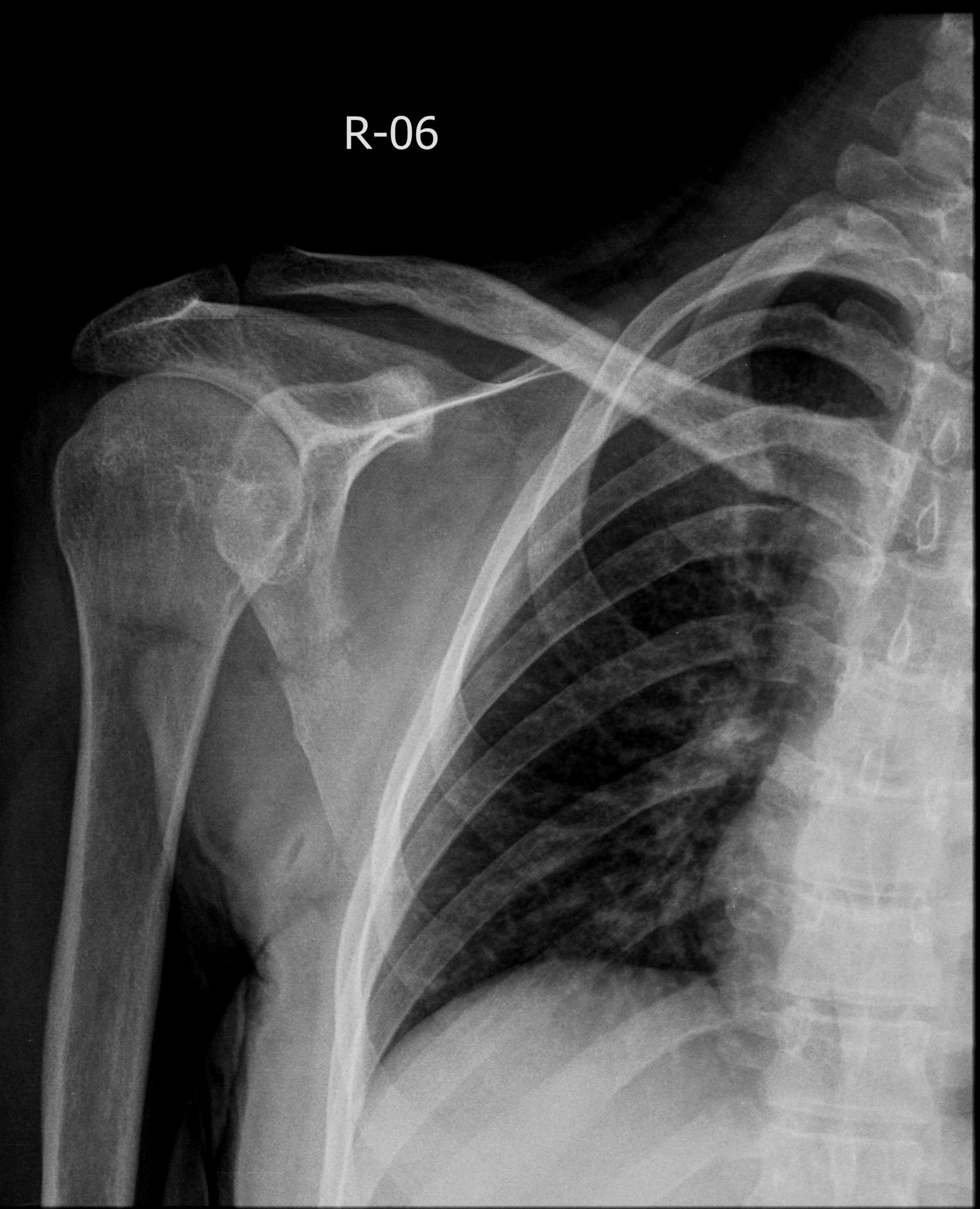 Scapular Fracture Image Radiopaedia Org