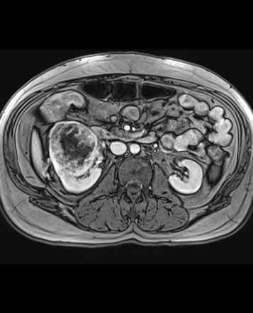 Synchronous Renal Cell Carcinoma And Colonic Adenocarcinoma Radiology