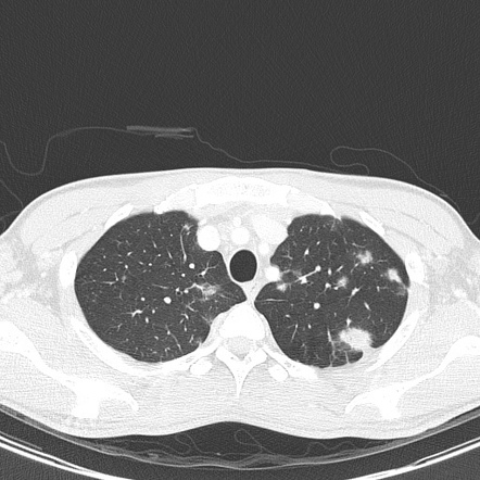 Kaposi Sarcoma Radiology Reference Article Radiopaedia Org