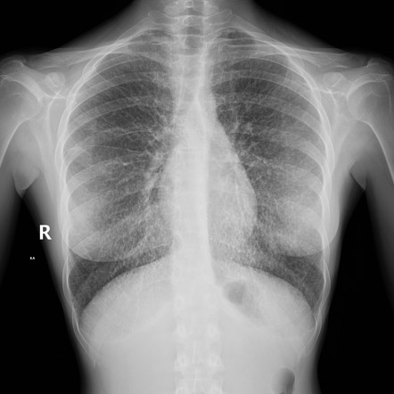 Pulmonary Alveolar Microlithiasis Radiology Reference Article Radiopaedia Org