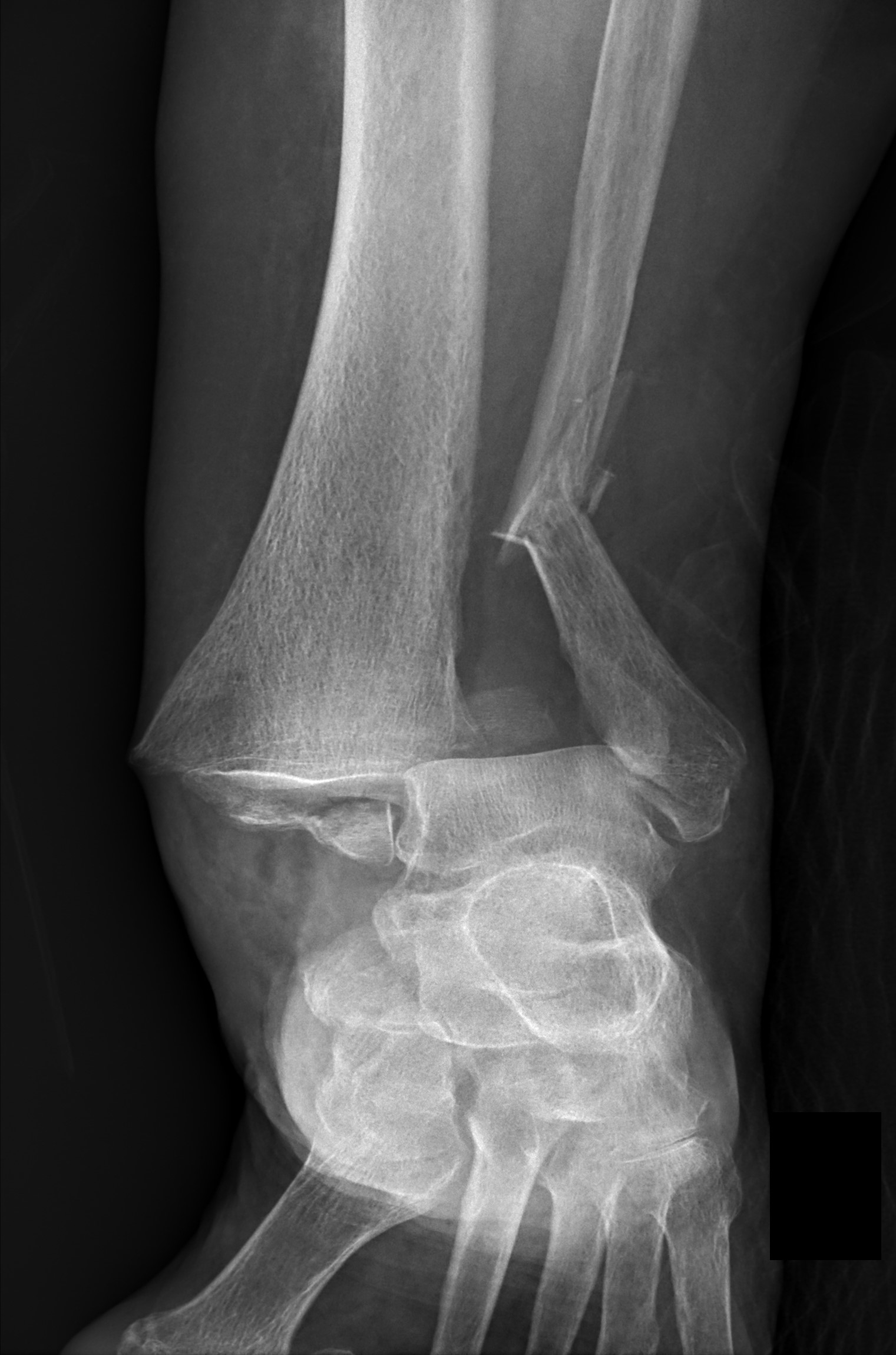 Trimalleolar Fracture Image Radiopaedia Org