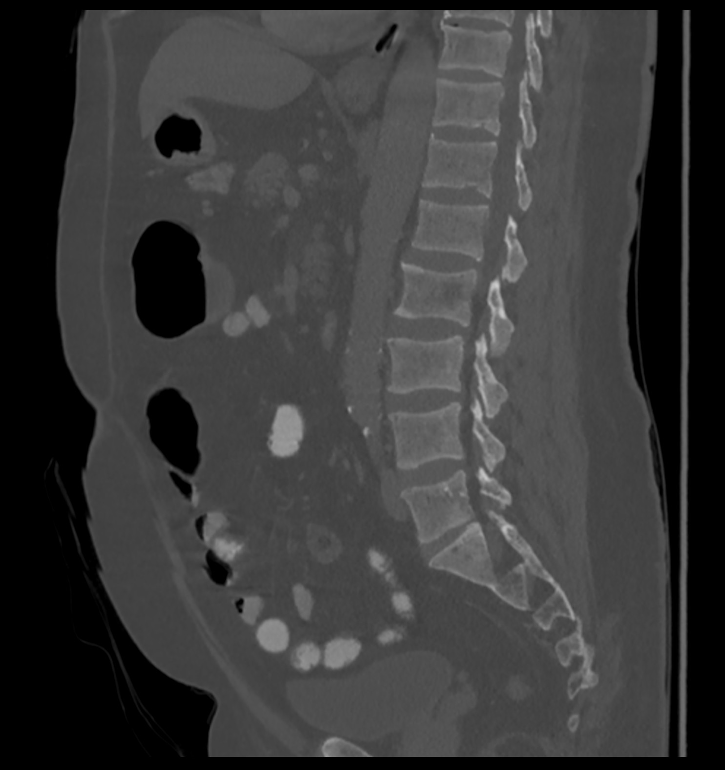 Synchronous Renal And Colonic Carcinomas Image Radiopaedia Org