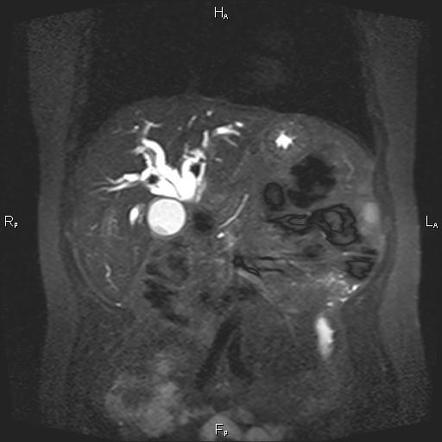 Mirizzi Syndrome Image Radiopaedia Org