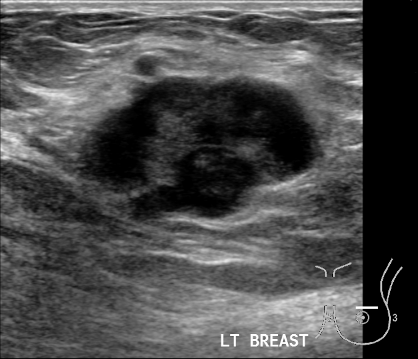 Intraductal Papilloma Of Breast Image Radiopaedia Org