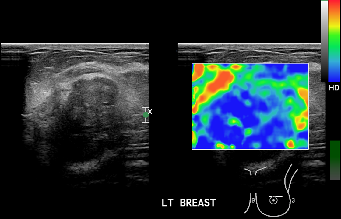 Intraductal Papilloma Of Breast Image Radiopaedia Org