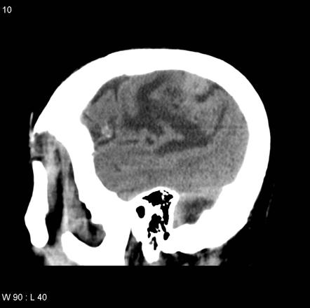 Meningioma Image Radiopaedia Org