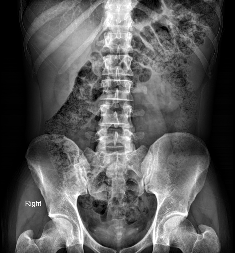 Urethral Stricture Image Radiopaedia Org