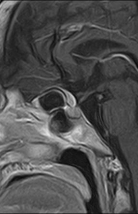 Planum Sphenoidale Meningioma Radiology Case Radiopaedia Org