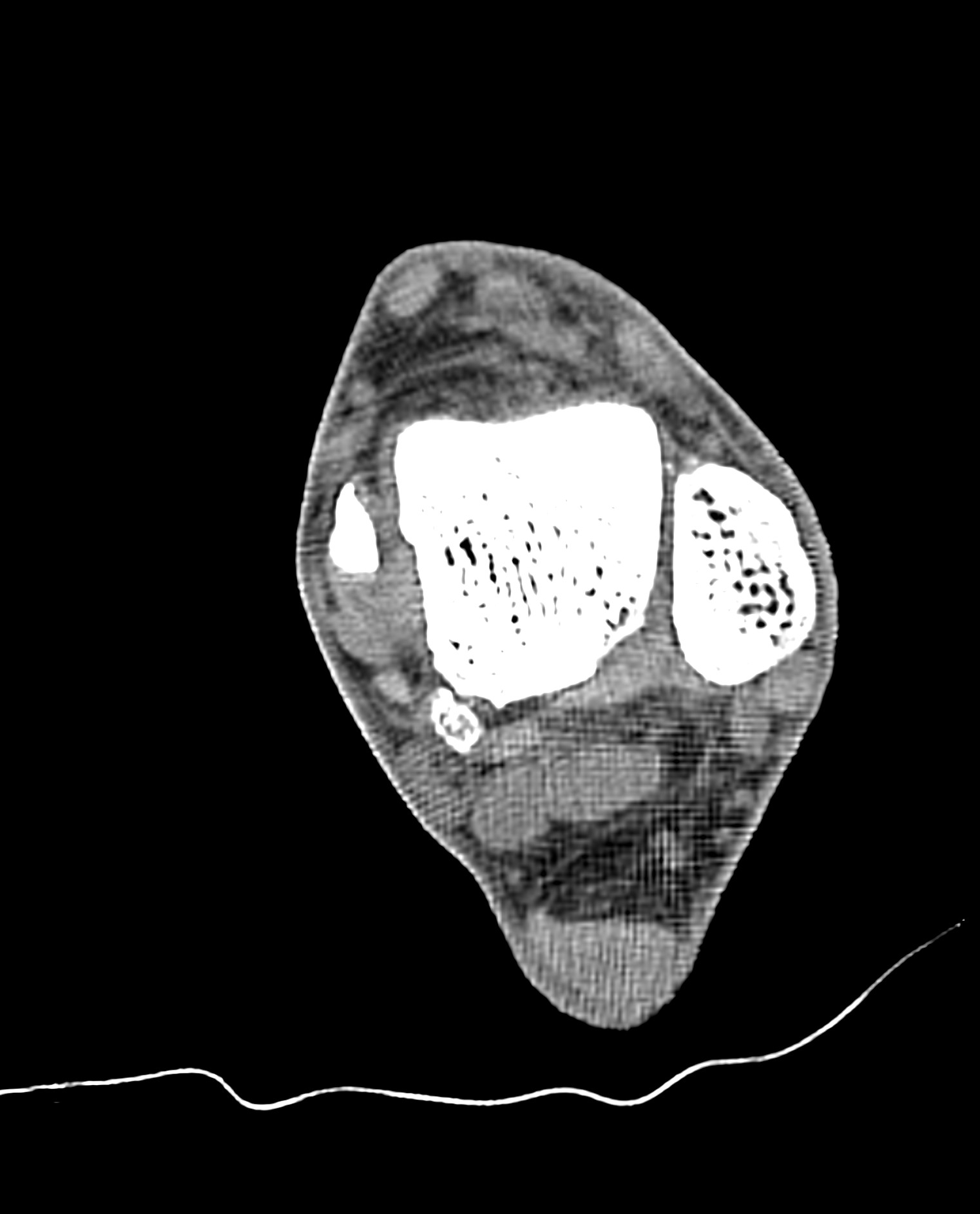 Insertional Achilles Tendinopathy And Calcific Enthesopathy Image Radiopaedia Org