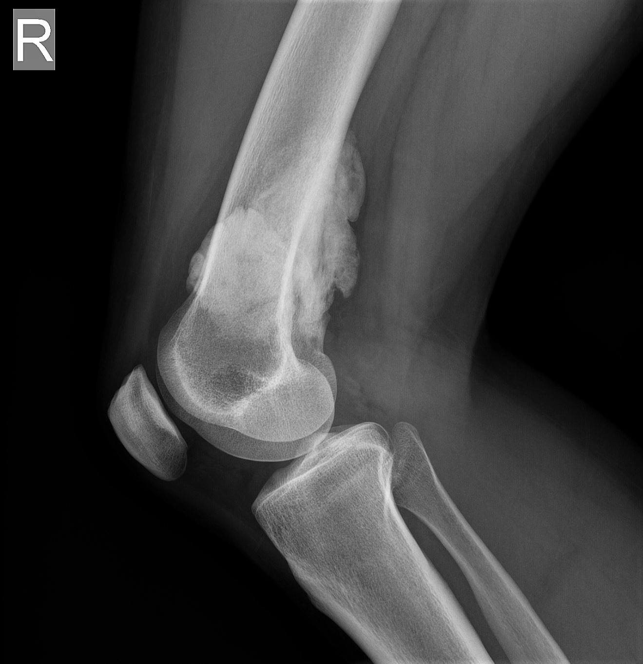 Parosteal Osteosarcoma With String Sign Image Radiopaedia Org