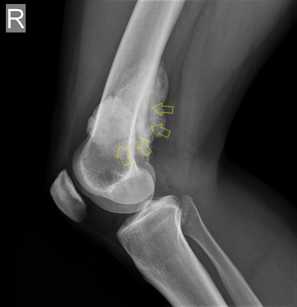 Parosteal Osteosarcoma With String Sign Image Radiopaedia Org