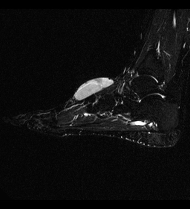 Neurofibroma Image Radiopaedia Org