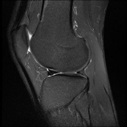 Double Delta Sign Meniscal Tear Radiology Reference Article Radiopaedia Org