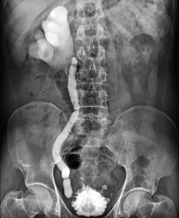 Unilateral Vesicoureteral Reflux Grade V Radiology Case