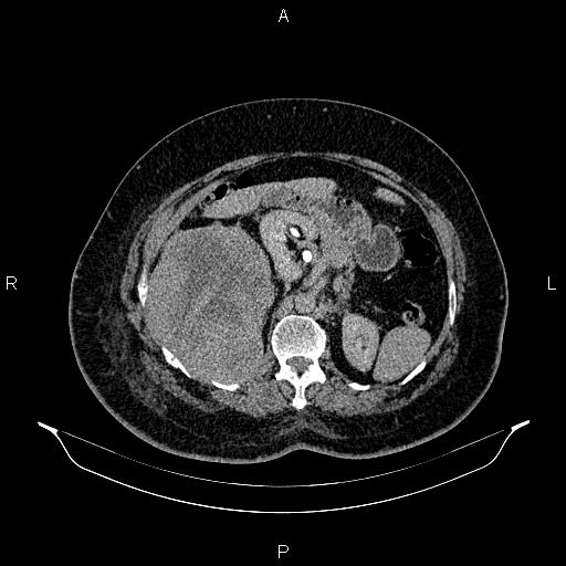 Retroperitoneal Sarcoma Image Radiopaedia Org