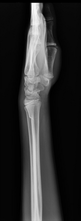 Greenstick Fracture Radiology Reference Article Radiopaedia Org