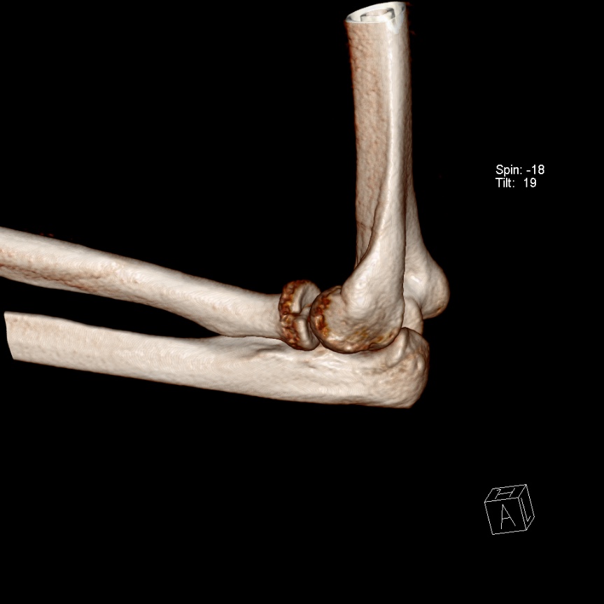 Radial Head Fracture Image Radiopaedia Org