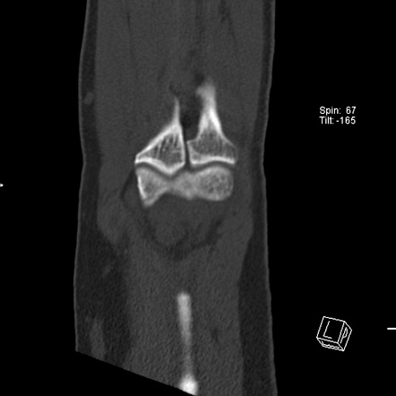 Radial Head Fracture Image Radiopaedia Org