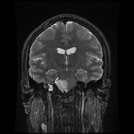 Acoustic Schwannoma Image Radiopaedia Org