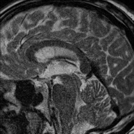 Quadrigeminal Cistern Lipoma Image Radiopaedia Org