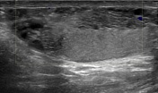 Tubular Ectasia Of Rete Testis Radiology Reference Article