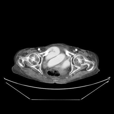 Incarcerated Obturator Hernia Radiology Case Radiopaedia Org