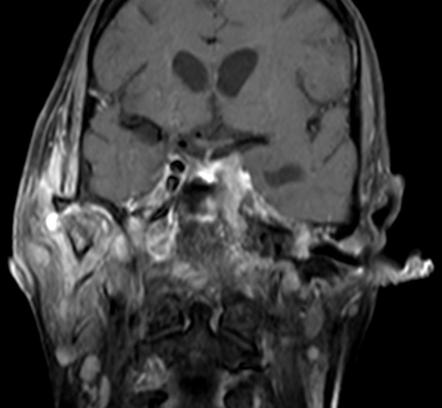 Osteomyelitis Radiology Reference Article Radiopaedia Org