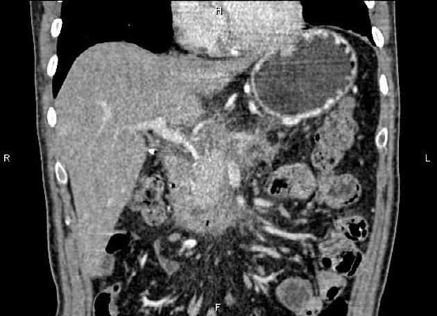 Necrotizing Pancreatitis Radiology Reference Article Radiopaedia Org