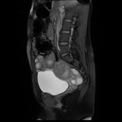 Ovarian Hyperstimulation Syndrome Radiology Reference Article