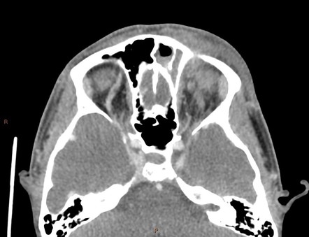 Cavernous Sinus Thrombosis Radiology Reference Article Radiopaedia Org