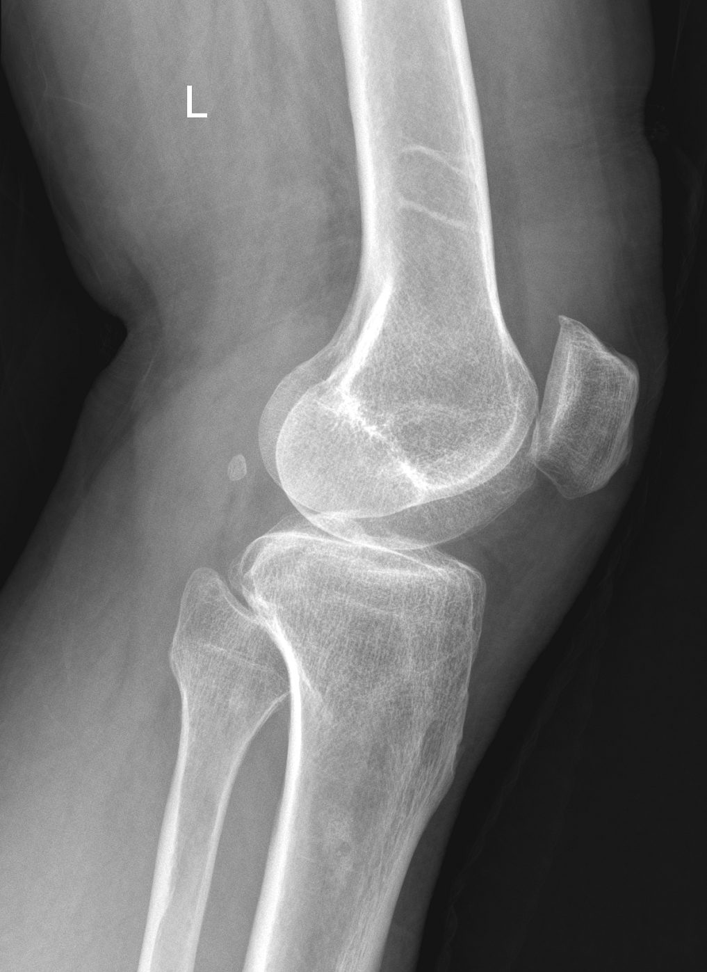 Avulsion Fracture Of The Tibial Eminence Image Radiopaedia Org