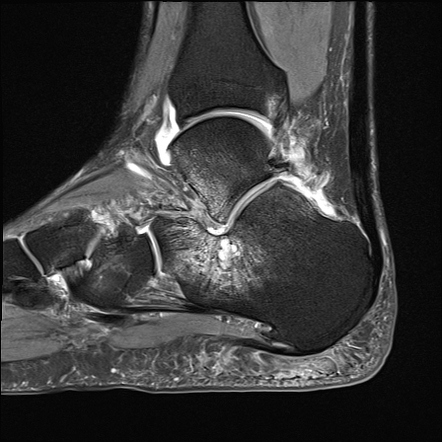 Extra Articular Lateral Hindfoot Impingement Radiology Case