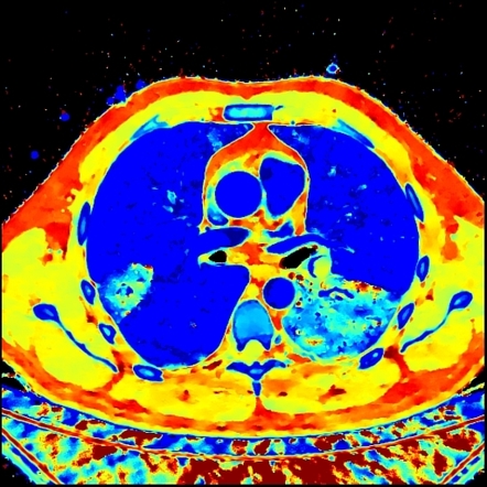 Superficial Femoral Artery Occlusion Image Radiopaediaorg