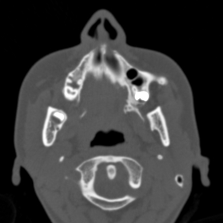 Temporomandibular Joint Ankylosis Image Radiopaedia Org