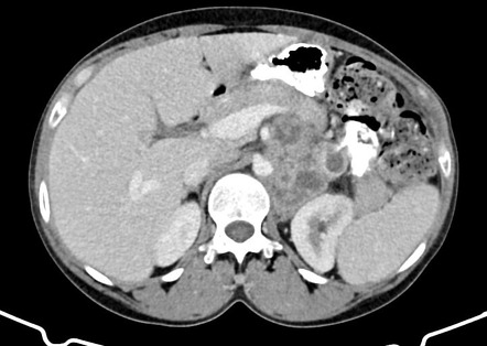 Abdominal Tuberculosis Radiology Reference Article Radiopaedia Org