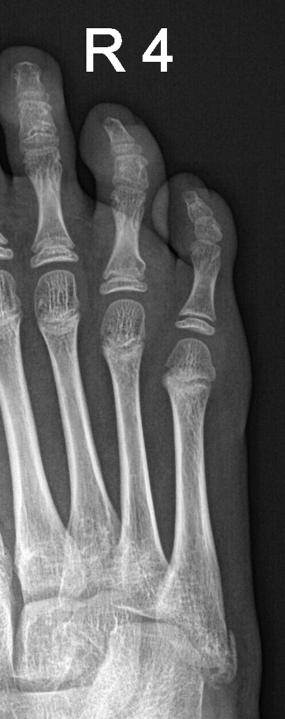 Proximal Phalangeal Torus Fracture Image Radiopaedia Org